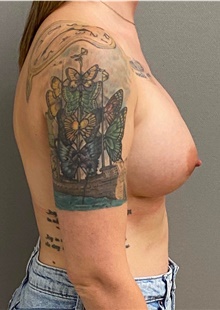 Breast Augmentation After Photo by Keshav Magge, MD; Bethesda, MD - Case 48455