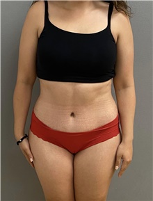Tummy Tuck After Photo by Keshav Magge, MD; Bethesda, MD - Case 48587