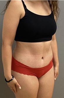 Tummy Tuck After Photo by Keshav Magge, MD; Bethesda, MD - Case 48587