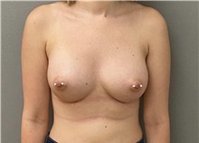 Breast Augmentation After Photo by Keshav Magge, MD; Bethesda, MD - Case 48597