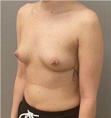 Breast Augmentation Before Photo by Keshav Magge, MD; Bethesda, MD - Case 48597