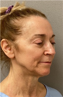 Facelift Before Photo by Keshav Magge, MD; Bethesda, MD - Case 48607