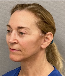 Neck Lift After Photo by Keshav Magge, MD; Bethesda, MD - Case 48608