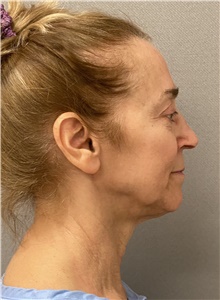 Neck Lift Before Photo by Keshav Magge, MD; Bethesda, MD - Case 48608