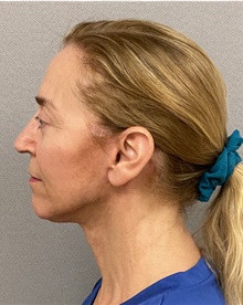Neck Lift After Photo by Keshav Magge, MD; Bethesda, MD - Case 48608