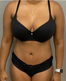 Tummy Tuck After Photo by Keshav Magge, MD; Bethesda, MD - Case 48609