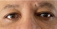 Eyelid Surgery After Photo by Keshav Magge, MD; Bethesda, MD - Case 48647