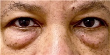 Eyelid Surgery Before Photo by Keshav Magge, MD; Bethesda, MD - Case 48647