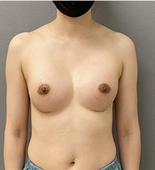 Breast Augmentation After Photo by Keshav Magge, MD; Bethesda, MD - Case 48648