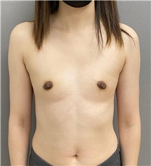 Breast Augmentation Before Photo by Keshav Magge, MD; Bethesda, MD - Case 48648