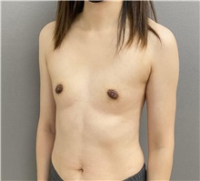 Breast Augmentation Before Photo by Keshav Magge, MD; Bethesda, MD - Case 48648