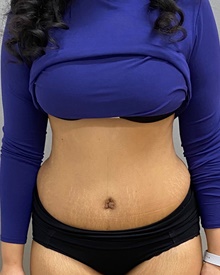 Tummy Tuck After Photo by Keshav Magge, MD; Bethesda, MD - Case 49122