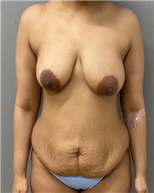 Tummy Tuck Before Photo by Keshav Magge, MD; Bethesda, MD - Case 49122