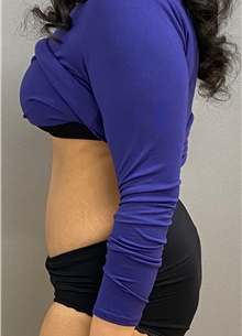 Tummy Tuck After Photo by Keshav Magge, MD; Bethesda, MD - Case 49122