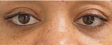 Eyelid Surgery After Photo by Keshav Magge, MD; Bethesda, MD - Case 49164