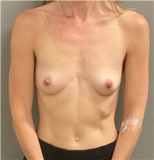 Breast Augmentation Before Photo by Keshav Magge, MD; Bethesda, MD - Case 49166