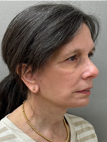 Facelift After Photo by Keshav Magge, MD; Bethesda, MD - Case 49180