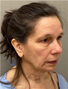 Facelift Before Photo by Keshav Magge, MD; Bethesda, MD - Case 49180