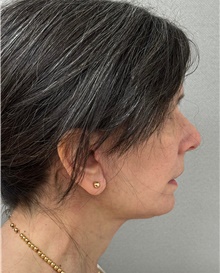 Facelift After Photo by Keshav Magge, MD; Bethesda, MD - Case 49180