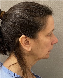 Facelift Before Photo by Keshav Magge, MD; Bethesda, MD - Case 49180