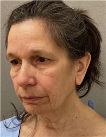 Facelift Before Photo by Keshav Magge, MD; Bethesda, MD - Case 49180