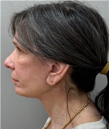 Facelift After Photo by Keshav Magge, MD; Bethesda, MD - Case 49180