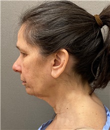 Facelift Before Photo by Keshav Magge, MD; Bethesda, MD - Case 49180