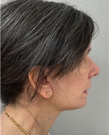 Neck Lift After Photo by Keshav Magge, MD; Bethesda, MD - Case 49182