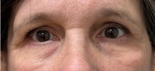 Eyelid Surgery After Photo by Keshav Magge, MD; Bethesda, MD - Case 49183