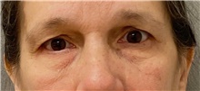 Eyelid Surgery Before Photo by Keshav Magge, MD; Bethesda, MD - Case 49183