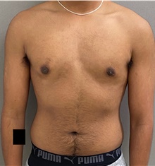 Male Breast Reduction After Photo by Keshav Magge, MD; Bethesda, MD - Case 49186