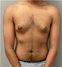 Male Breast Reduction Before Photo by Keshav Magge, MD; Bethesda, MD - Case 49186