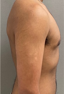 Male Breast Reduction After Photo by Keshav Magge, MD; Bethesda, MD - Case 49186