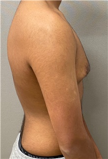 Male Breast Reduction Before Photo by Keshav Magge, MD; Bethesda, MD - Case 49186