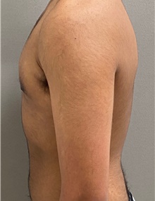 Male Breast Reduction After Photo by Keshav Magge, MD; Bethesda, MD - Case 49186