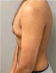 Male Breast Reduction Before Photo by Keshav Magge, MD; Bethesda, MD - Case 49186