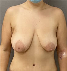 Breast Lift Before Photo by Keshav Magge, MD; Bethesda, MD - Case 49187