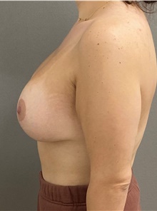 Breast Lift After Photo by Keshav Magge, MD; Bethesda, MD - Case 49187