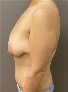 Breast Lift Before Photo by Keshav Magge, MD; Bethesda, MD - Case 49187