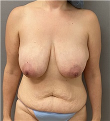 Breast Lift Before Photo by Keshav Magge, MD; Bethesda, MD - Case 49193