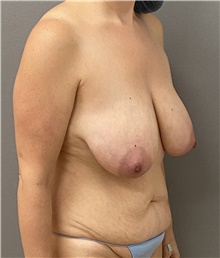 Breast Lift Before Photo by Keshav Magge, MD; Bethesda, MD - Case 49193