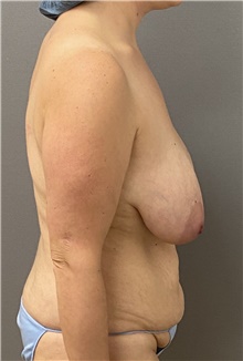 Breast Lift Before Photo by Keshav Magge, MD; Bethesda, MD - Case 49193