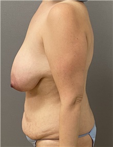 Breast Lift Before Photo by Keshav Magge, MD; Bethesda, MD - Case 49193