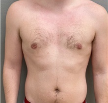 Male Breast Reduction After Photo by Keshav Magge, MD; Bethesda, MD - Case 49197