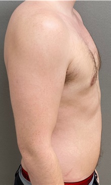 Male Breast Reduction After Photo by Keshav Magge, MD; Bethesda, MD - Case 49197