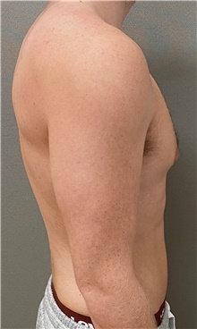 Male Breast Reduction Before Photo by Keshav Magge, MD; Bethesda, MD - Case 49197