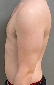 Male Breast Reduction After Photo by Keshav Magge, MD; Bethesda, MD - Case 49197