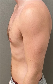 Male Breast Reduction Before Photo by Keshav Magge, MD; Bethesda, MD - Case 49197