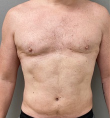 Male Breast Reduction After Photo by Keshav Magge, MD; Bethesda, MD - Case 49198