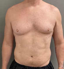 Male Breast Reduction Before Photo by Keshav Magge, MD; Bethesda, MD - Case 49198